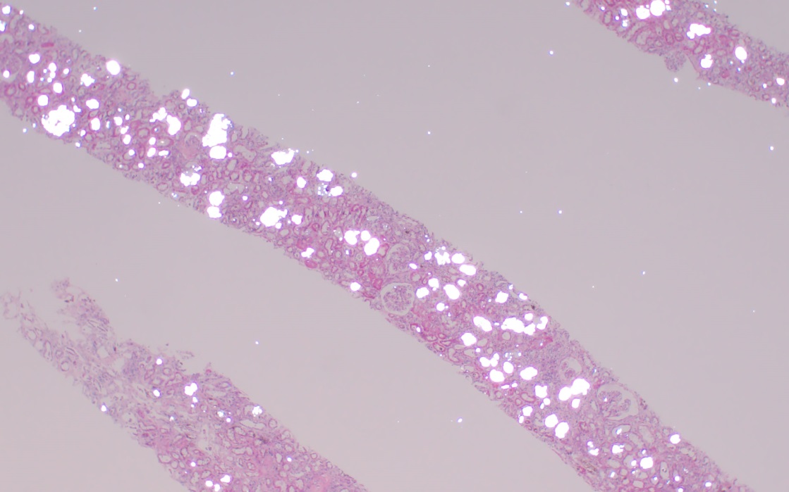 TOO MUCH OF A GOOD THING? VITAMIN C INDUCED OXALATE NEPHROPATHY SHM
