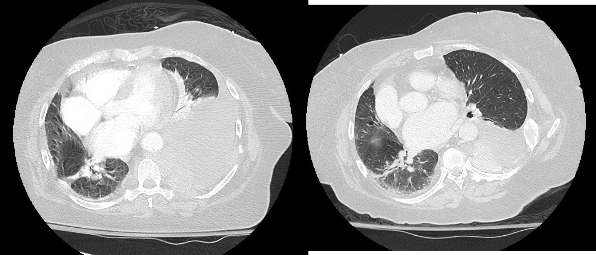 ち*ぷ様 ディアステマDiastema cf. fimbriatoloba AN UNUSUAL PRESENTATION OF A USUAL MALIGNANCY: A CASE OF