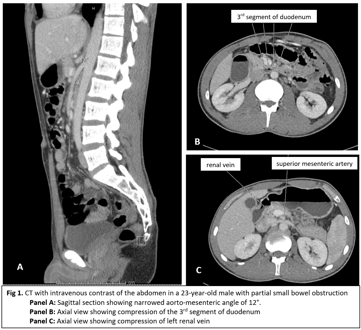 WILKIE'S AND NUTCRACKER SYNDROMES SHM Abstracts Society of Hospital