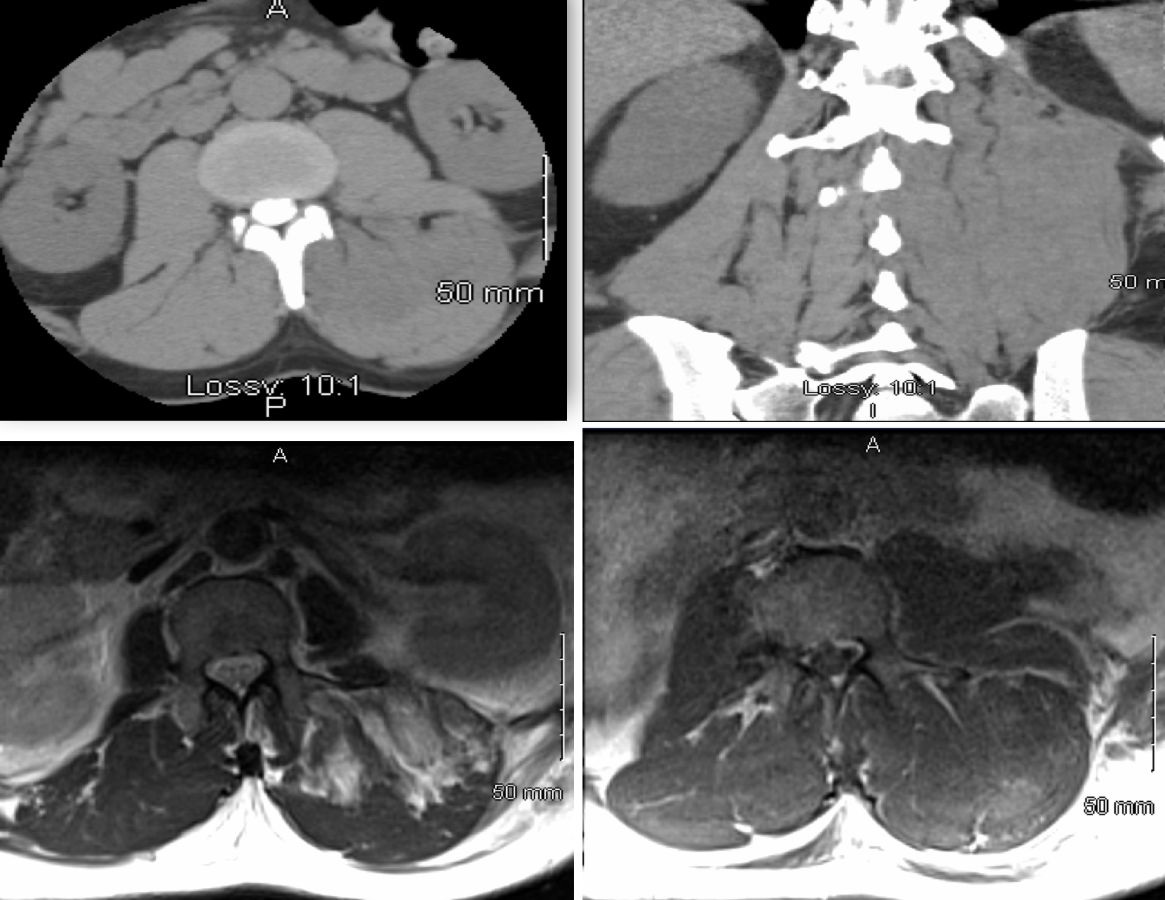 A CASE OF ACUTE PARASPINAL AND GLUTEAL COMPARTMENT SYNDROME SHM