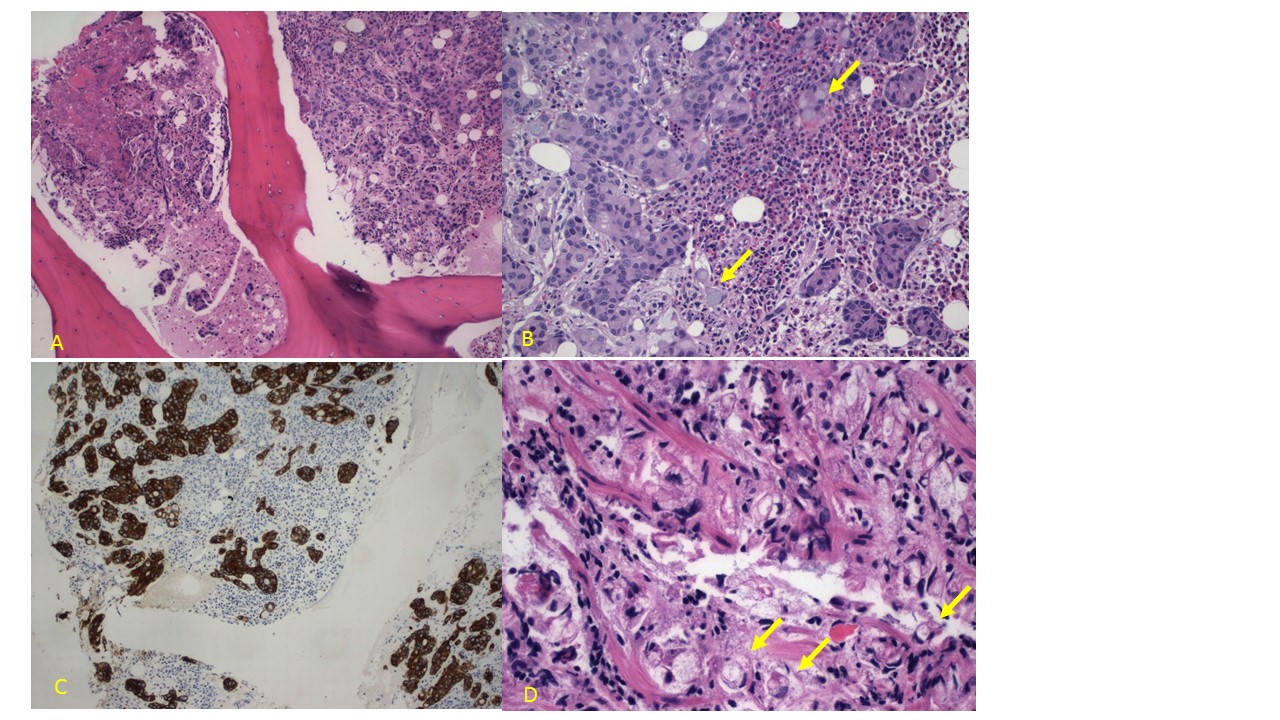 Signet-ring cells in pleural and peritoneal effusions identified on Wright  stains – A diagnostic pitfall - CytoJournal